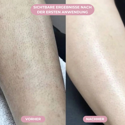 FLOAMMI - IPL Hair Removal